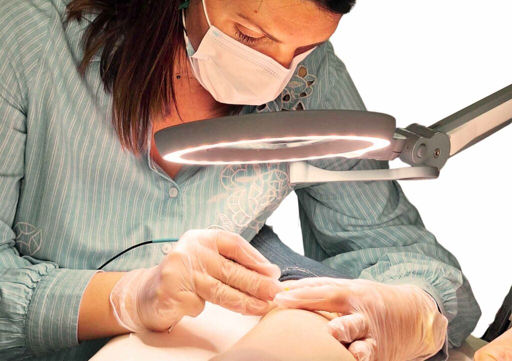 Epilation définitive par thermolyse.